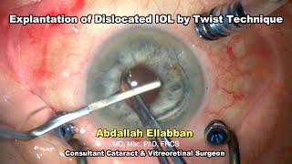 Explantation of dislocated IOL by twist technique