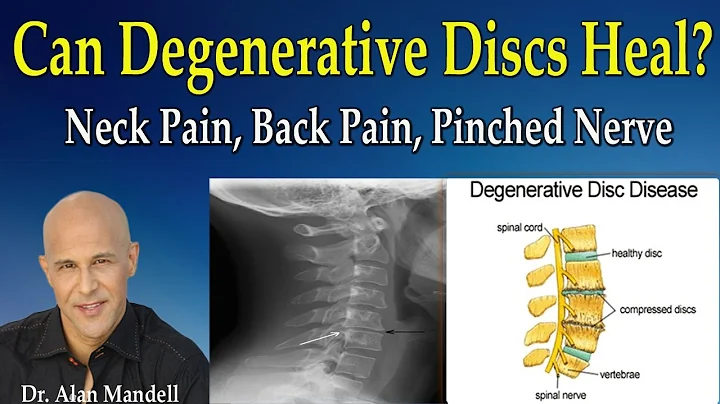 Can Degenerative Discs Heal Normal Again?  (Neck Pain, Back Pain, Pinched Nerve) - Dr Mandell - DayDayNews