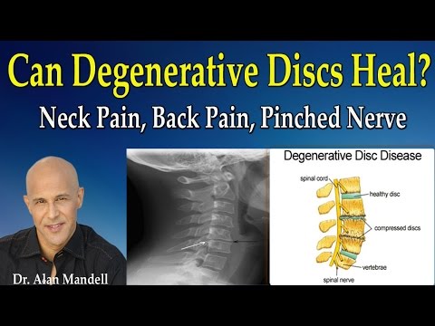 Can Degenerative Discs