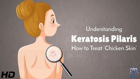 Chicken Skin Cure: What Actually Works for Keratosis Pilaris?