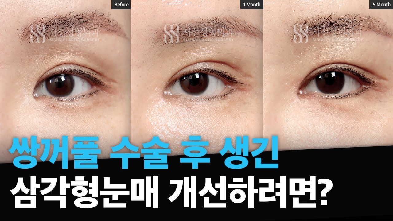 쌍수 후 만들어진 삼각형눈매, 어떻게 개선해야 할까요? - YouTube