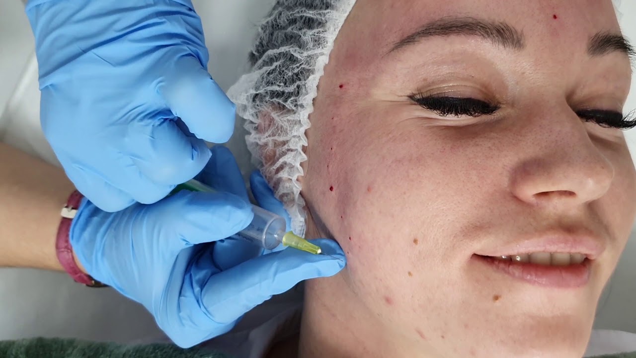 Озонотерапия лица Основич Марина Леонидовна ЭЛАР