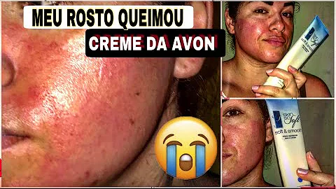 Como tirar mancha de queimadura de creme depilatório?