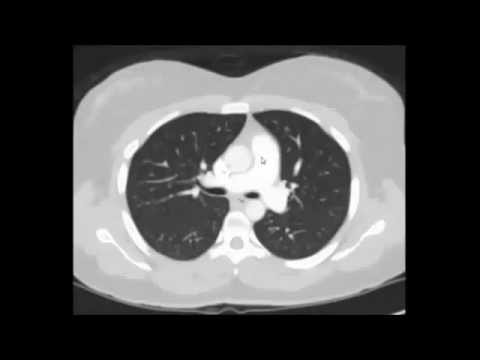 Vídeo: Assinaturas Radiômicas Baseadas Em TC Com Múltiplas Janelas Na Diferenciação De Câncer De Pulmão Indolente E Agressivo No National Lung Screening Trial: Um Estudo Retrospectivo