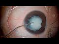 Surgery: Congenital Total Cataract