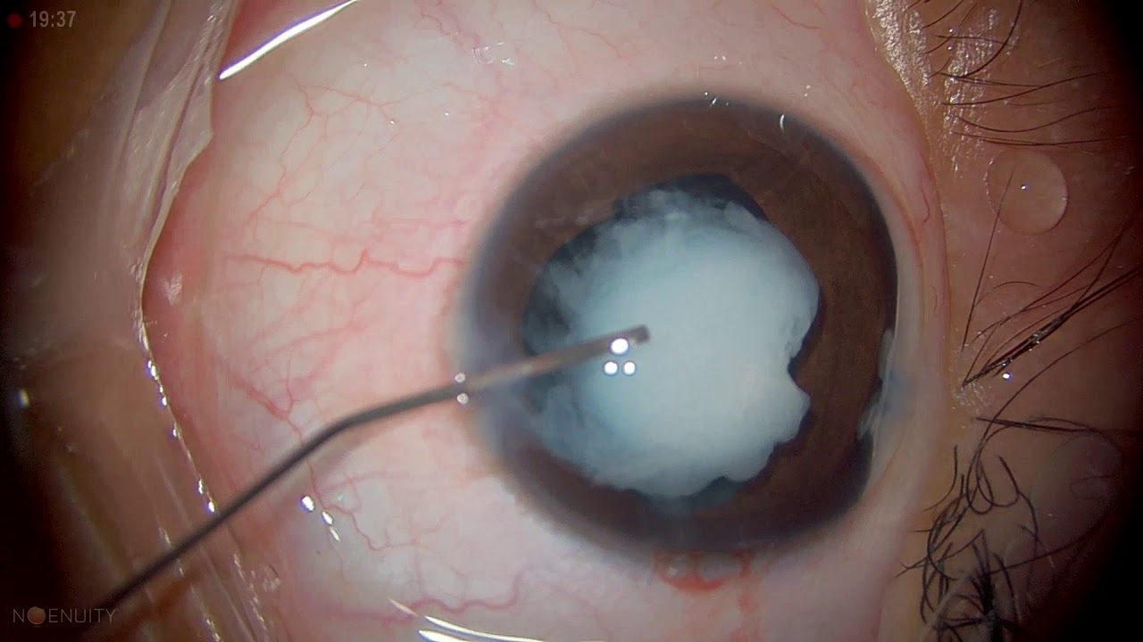 Surgery: Congenital Total Cataract - YouTube