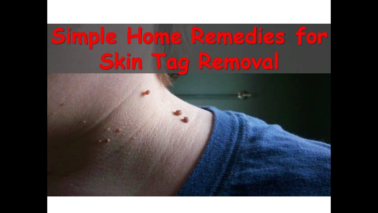 Best Natural Home Remedies To Remove Skin Tags Simple Remedies For Skin Tag Removal Youtube
