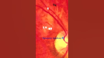 Tessellated Fundus | Indirect Ophthalmoscopy | Smartphone Fundus Videography | Short Video 256