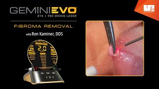 Fibroma Removal | Gemini EVO™ clinical cases