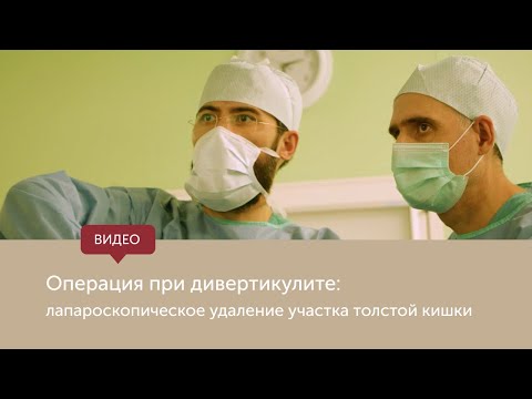 Операция при дивертикулите: лапароскопическое удаление участка прямой кишки