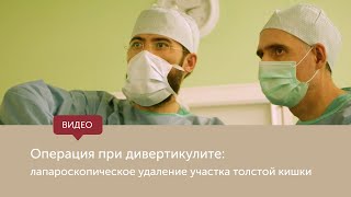 Операция при дивертикулите: лапароскопическое удаление участка прямой кишки