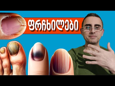 რას გვეუბნება ფრჩხილები ჯანმრთელობაზე   (მსხვრევადი, სწორი ხაზები, თეთრი ლაქები)