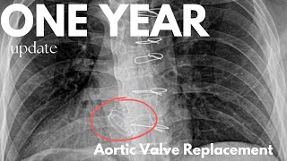 Full 1 Year Update - Post Aortic Valve Replacement Surgery Update
