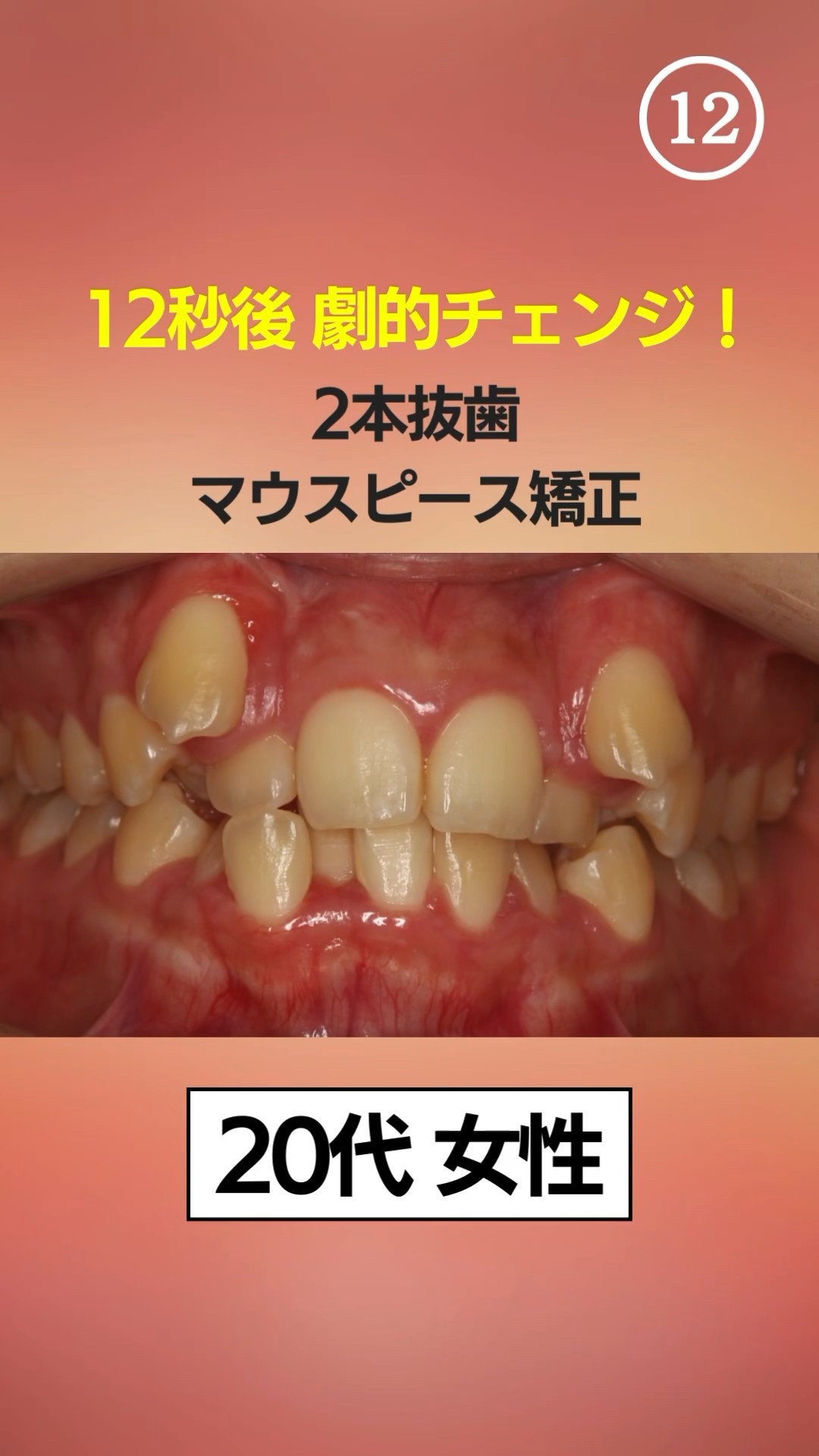 ワイヤーではなくマウスピース矯正で治したい方必見#shorts