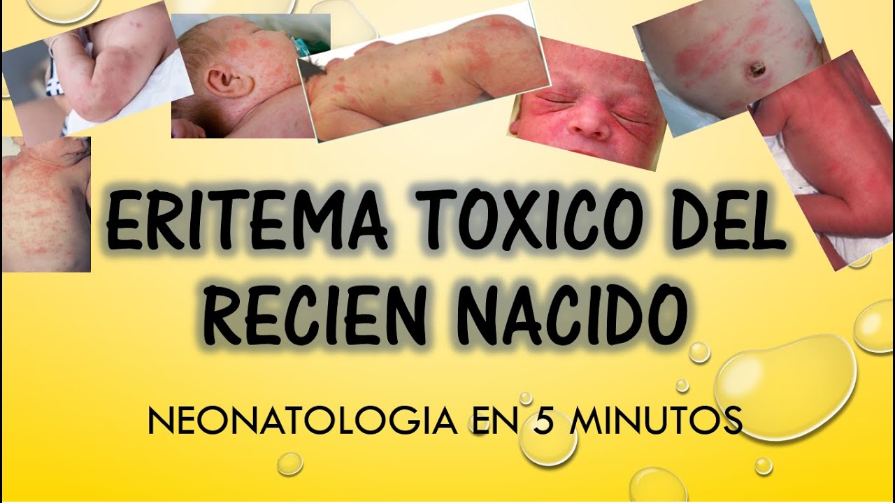 Eritema Toxico Del Recien Nacido Gpc www.youtube.com