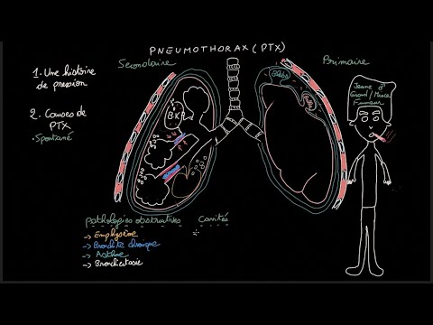 Vidéo: Pneumothorax Du Poumon