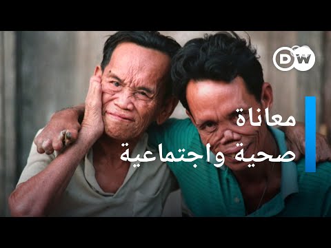الجذام لماذا يمثل القضاء عليه تحديا كبيرا الأخبار