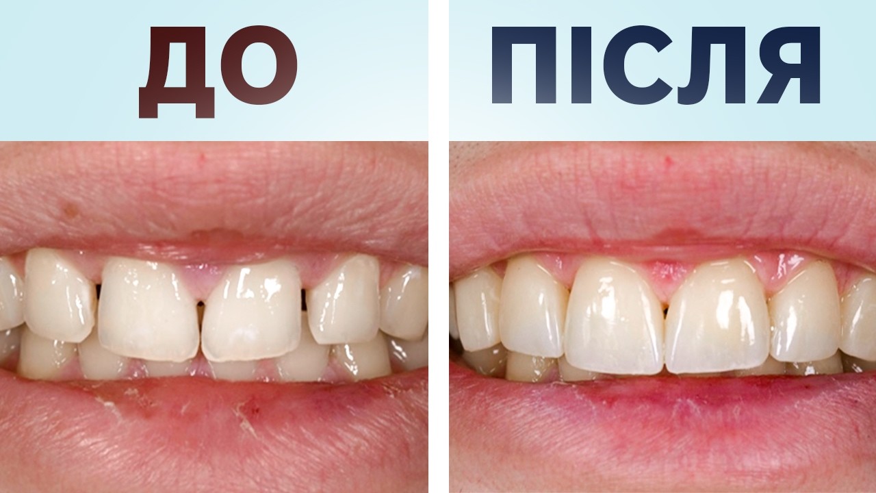 Посмішка без МЕЖ: корекція діастеми та трем за допомогою композиту та кераміки