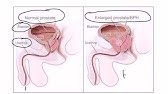 hogyan ellenőrizze hogy van- e prostatitis