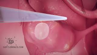 Gel treatment method Uterus #3dmedicalanimation Resimi