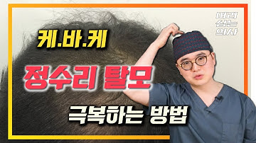 정수리 탈모 치료 알고하자!