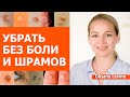 Безопасные способы удаления. Убрать без боли и шрамов. Папилломы . Бородавки. Контагиозный моллюск