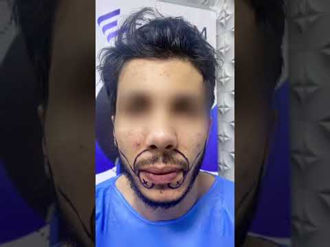 زراعة اللحية وإليكم النتيجة بعد 6 أشهر من الزراعة ليبيا ليبيا طرابلس ليبيا مصراته