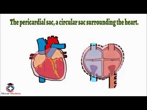 Cardiac Tamponade- Pulsus Paradoxus