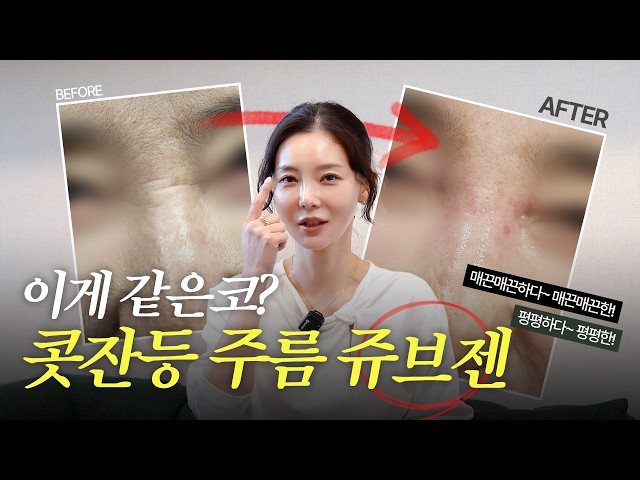 [EN] 쥬브젠이면 가능! 👍🏻 콧잔등주름 👃🏻 필러, 보톡스만이 답이 아닙니다 🙅🏻‍♀️