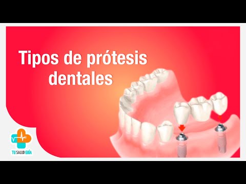 Vídeo: Tipos De Prótesis Dentales