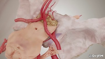 Skull Base Meningioma Animation