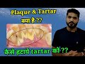 डेंटल प्लाक और टार्टर ?? कैसे बनते है, क्या problem करते है और कैसे साफ करे ??Dental plaque & Tartar