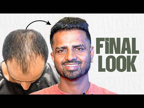 Grade 5 Baldness Reversed in 1 Year 🤩 | Hair Transplant Nashik | New Roots