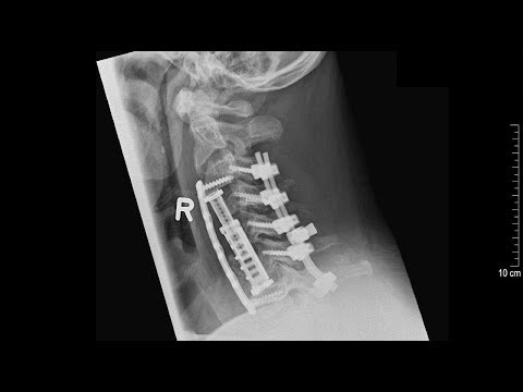 C5 Palsy: Komplikation bei Operationen der HWS