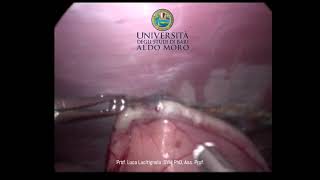 Total Laparoscopic Gastropexy with Ethicon SecureStrap
