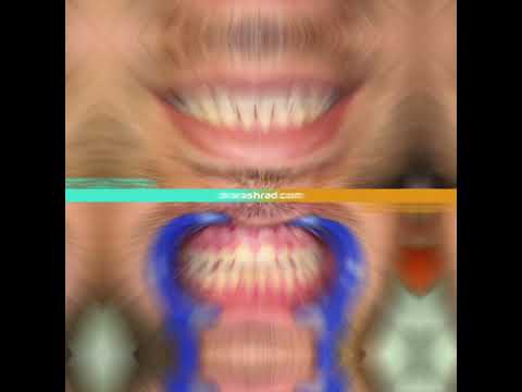 نتیجه جرم گیری دندان توسط دکترغزال آرش راد