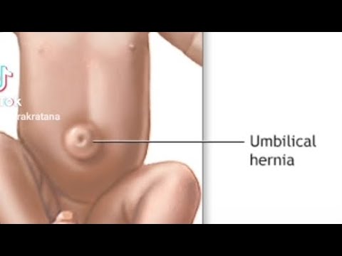 វិធីជួយឲ្យក្មេងឆាប់បាត់ប៉ោងលៀនផ្សិត(ផ្ចិត) #umbilicalhernia #health #viral #baby #subscribe
