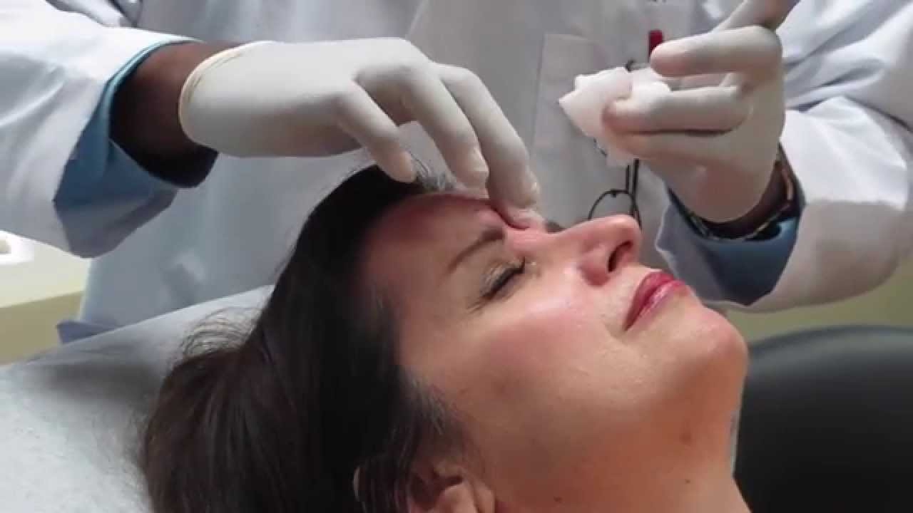 BOTOX Procedure on the glabella area & lines by Roland