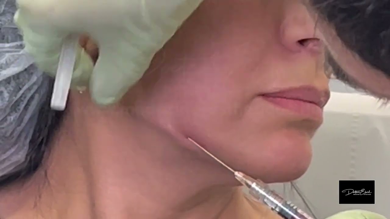 Raffermissement de l’Ovale du Visage à l'Acide Hyaluronique | Expertise en Médecine Esthétique Paris