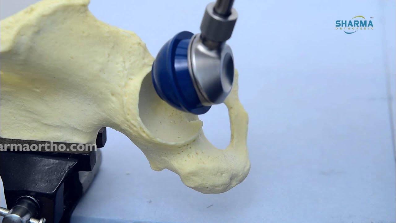 Total Hip Replacement System Cemented YouTube