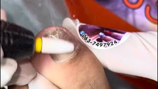Ep_6095 Ingrown toenail removal  เล็บแบบหนูต้องใช้เวลาในการเลี้ยง  (clip from Thailand)