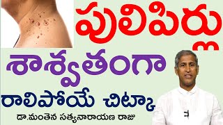 పులిపిర్లు శాశ్వతంగా రాలిపోవాలంటే |Home remedy For Remove Warts | Manthena Satyanarayana Raju Videos