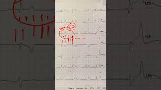 Hyperkalemia - Peaked T-Waves - and ECG Recognition