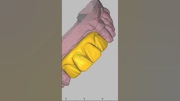 #surgicalguide #dentistry #exocad #dental #crown #dentalsurgeon #implant #اكسبلور