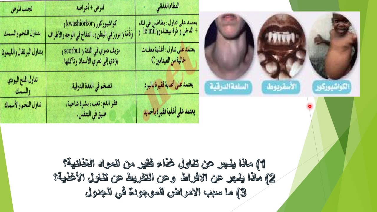الدرس 7: أتعرف على عواقب سوء التغذية علوم طبيعية 1 متوسط
