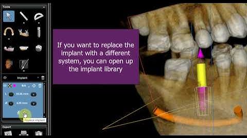 Using CS 3D Imaging Software for Implant Planning