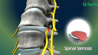 Micro Lumbar Discectomy & Fusion ( Spine Surgery) Neuro Surgery; Fortis Healthcare,India