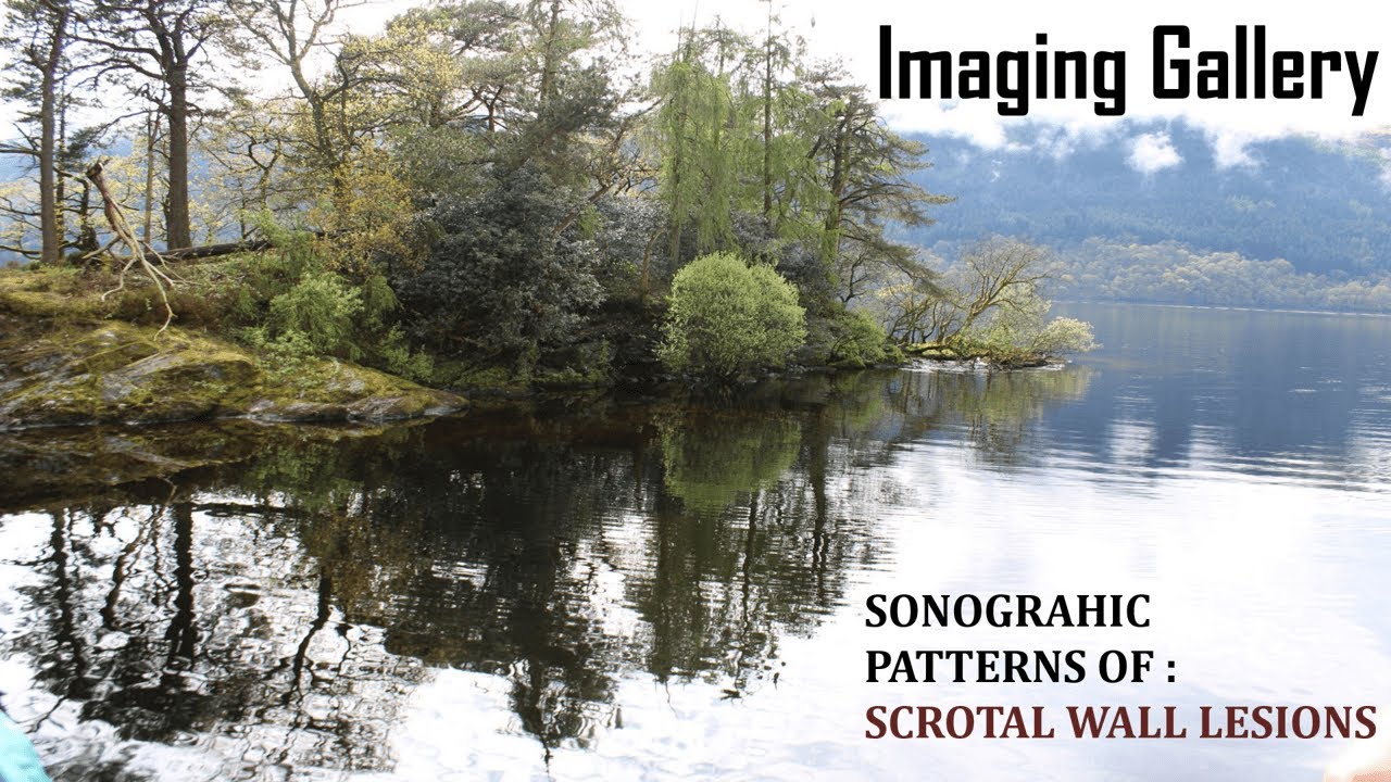 SONOGRAPHIC PATTERNS OF SCROTAL WALL LESIONS - BY DR ANIL JOSHI .