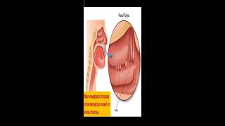 Nasal polyps surgery topic