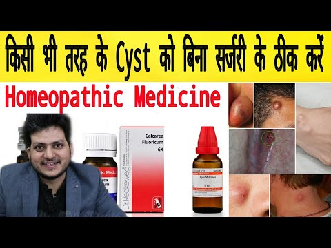 Cyst | Homeopathic Medicine for All type of Cyst ? Remove 100%